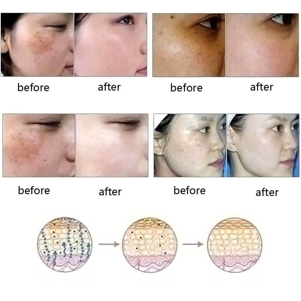 Dredge Meridian Skin Care Natural Pure Removal Acne Stretch Marks Scar Removal Essence oil زيت دريدج ميريديان للعناية بالبشرة، طبيعي ونقي، لإزالة حب الشباب وعلامات التمدد والندبات